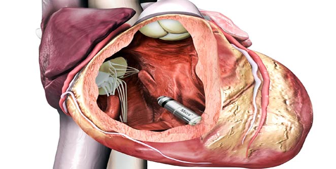 pacemaker