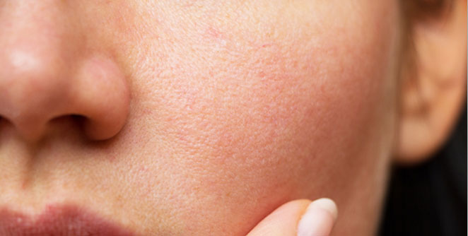 pores2