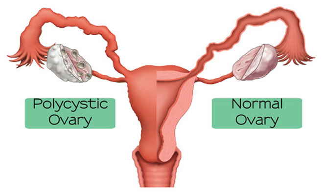 PCOS2