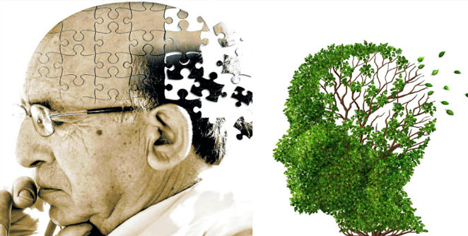 Alzheimer