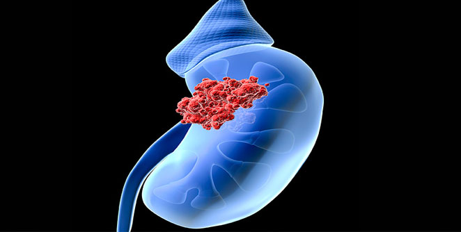 kidney1