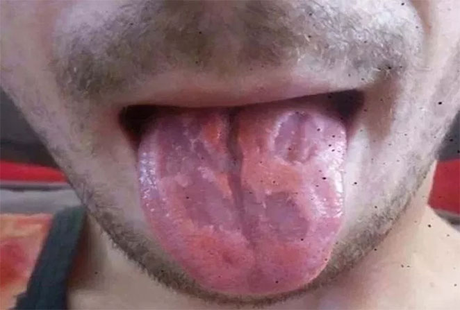 tongue3